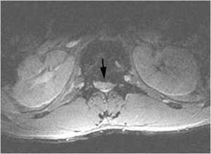 normal emg herniated disc