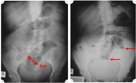 Small Bowel Obstruction - AXR