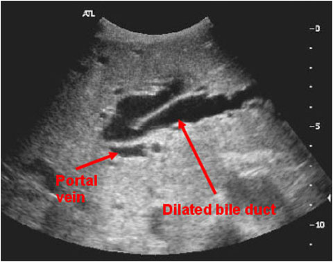 Dilated Bile Duct