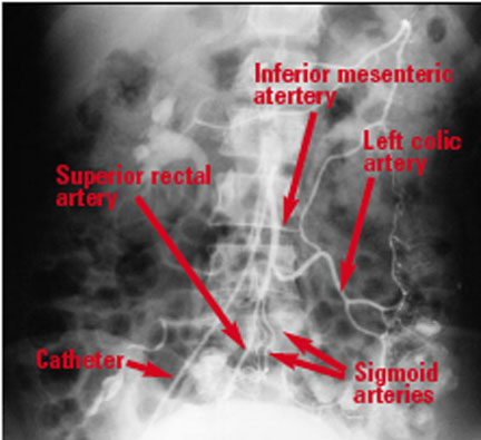 Inferior Mesenteric Arteriogram