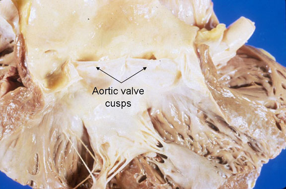 Normal aortic valves