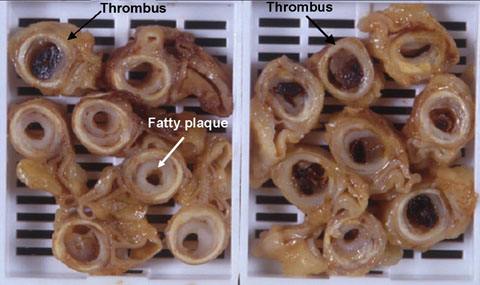 Atherosclerosis Cross Sections