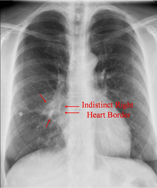 Right Middle Lobe - Evaluate
