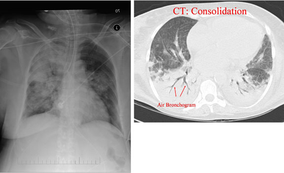 Consolidation - Air Bronchogram