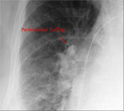 Pulmonary Edema - Peribronchial Cuffing