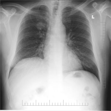 Pulmonary Nodules