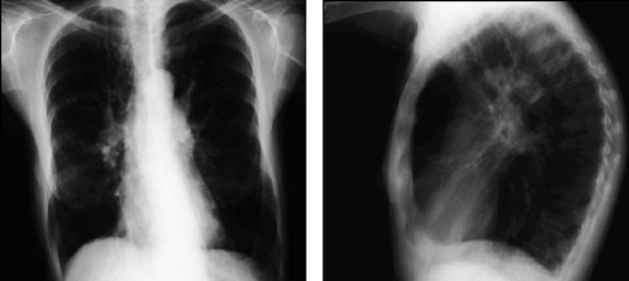 Emphysema - PA and Lateral Film