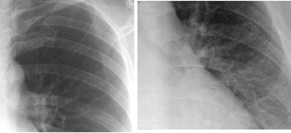 Pulmonary Vasculature Redistribution