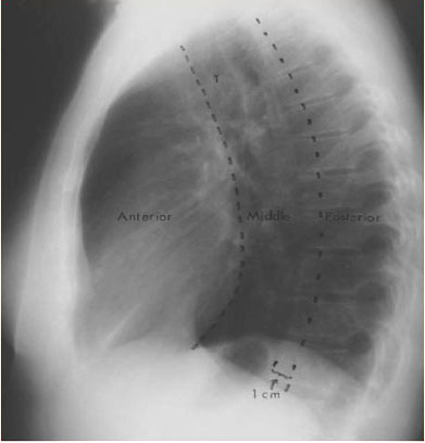 Felsons Divisions of the Mediastinum