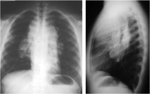 Anterior Mediastinal Mass