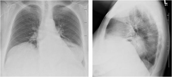 Middle Mediastinal Mass