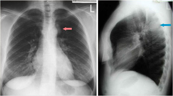 Posterior Mediastinal Mass