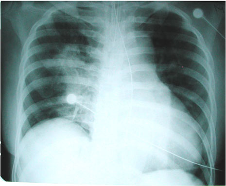 Pulmonary Contusion
