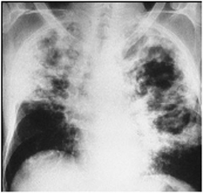 Active Tuberculosis