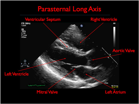 Parasternal Long Axis View