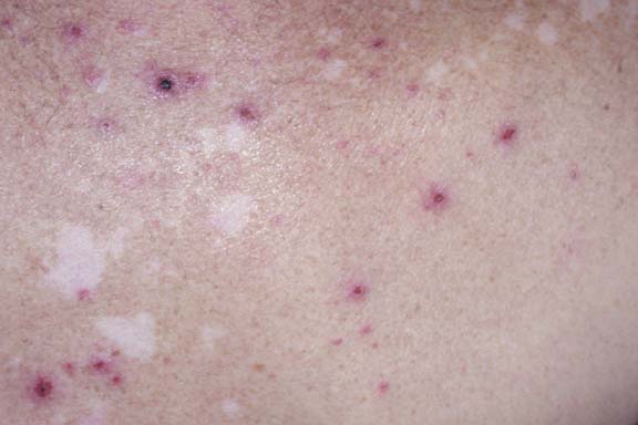 Erythema Multiforme EM No.2