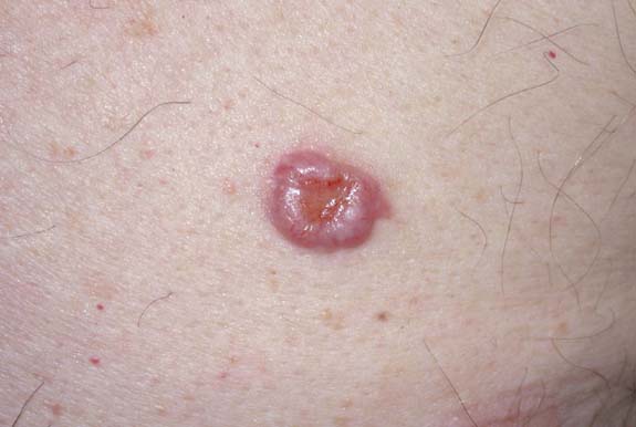 Basal Cell Carcinoma No. 3