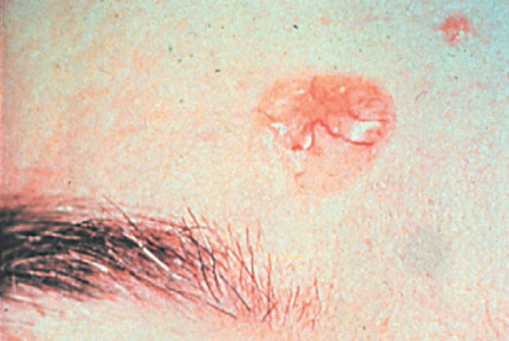 Basal Cell Carcinoma No. 2