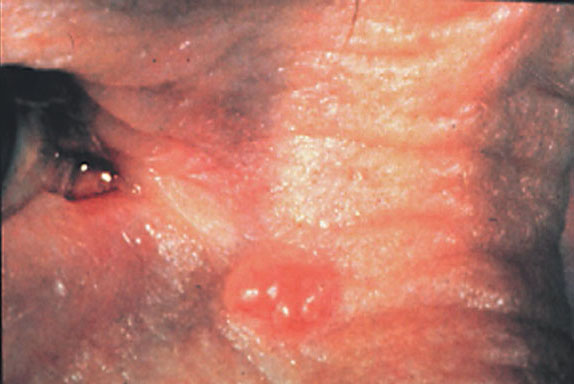 Basal Cell Carcinoma No. 1