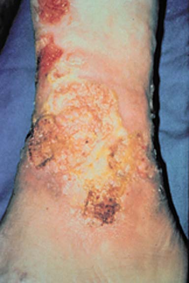 Squamous Cell Carcinoma