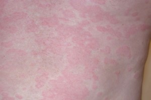 Urticaria – Toronto Notes