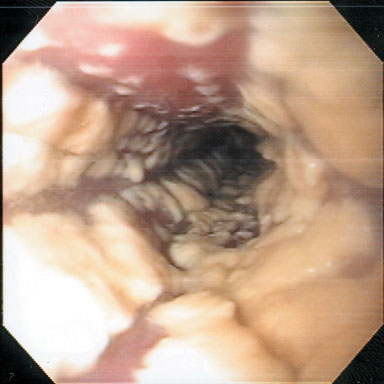 Candida Esophagitis