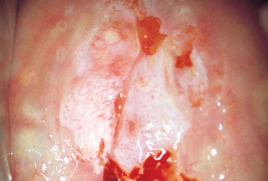 Invasive Cervical Lesion