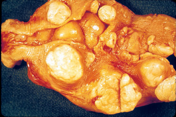 Leiomyoma - Uterus