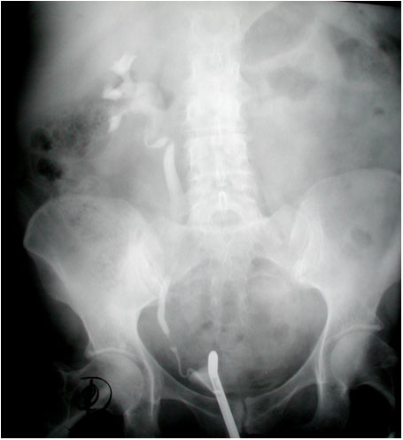 Ureteric Obstruction