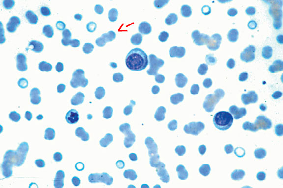 Plasma Cell Myeloma