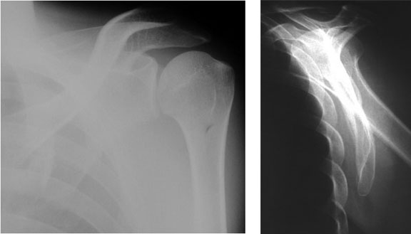 X-Ray of the Shoulder