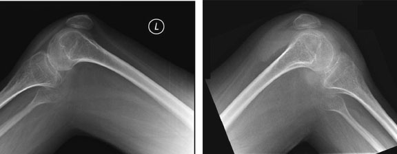 Fracture Associated Sign