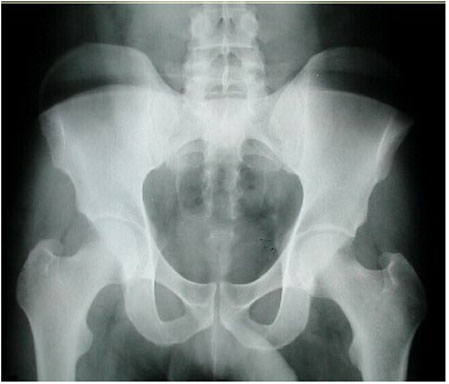 X-ray of the Hip