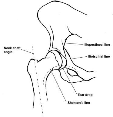 Schematic of the Hip