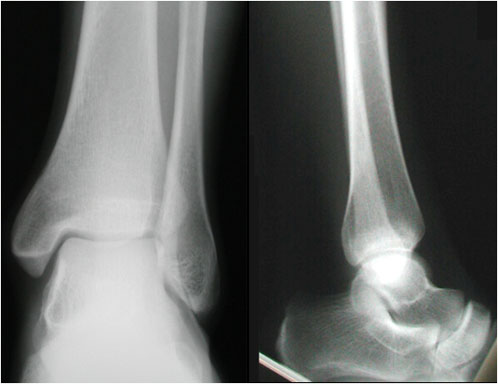 X-Ray of the Ankle