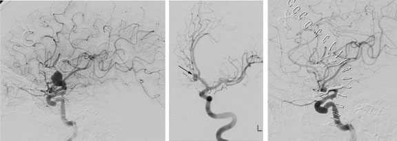 Aneurysms in the Circle of Willis