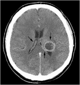 Thalamic Glioma – Toronto Notes