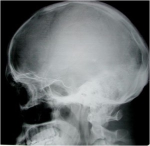 skull fracture icd 10