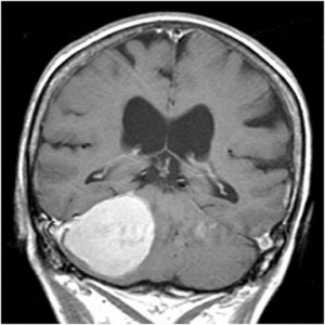 Posterior Fossa Meningioma – Toronto Notes