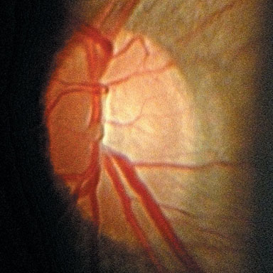 Central Retinal Artery Occlusion - CRAO