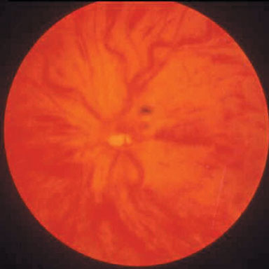 Central Retinal Vein Occlusion - CRVO