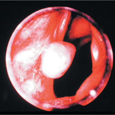 Laryngeal Granuloma