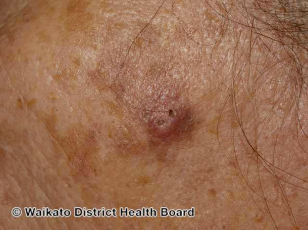 Squamous Cell Carcinoma Toronto Notes 