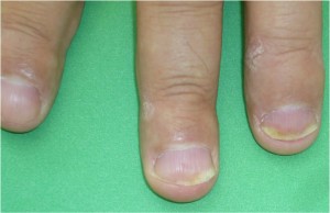 Psoriatic Arthritis – Onycholysis – Toronto Notes