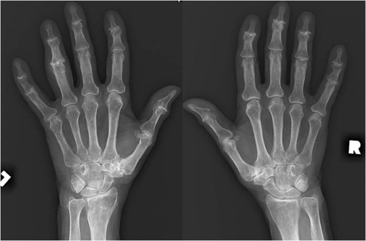 Bilateral hand radiographs