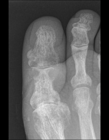 Left toe radiograph