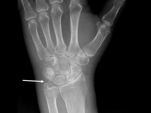 Right wrist radiograph