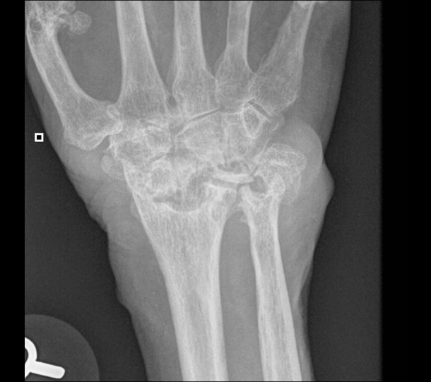 Right hand radiograph in a patient with advanced rheumatoid arthritis
