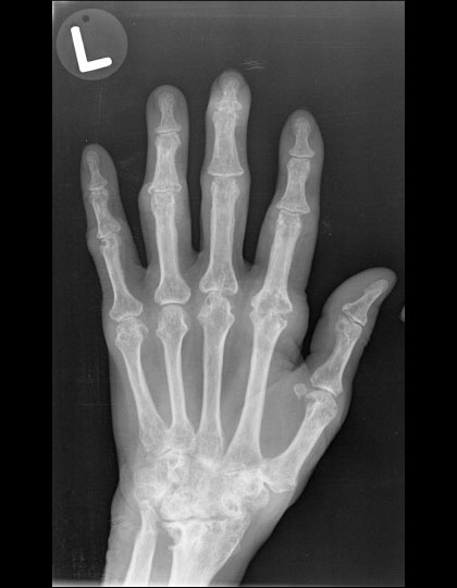 Left hand radiograph in a patient with rheumatoid arthritis