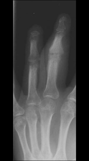 Ring and long digit radiograph in a patient with psoriatic arthritis